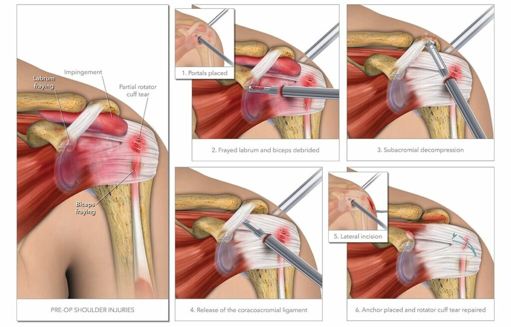 Shoulder Injury Settlement with Surgery