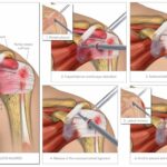 Shoulder Injury Settlement with Surgery